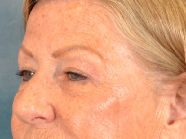 Eyelid Lift Before & After Gallery - Patient 293080 - Image 7