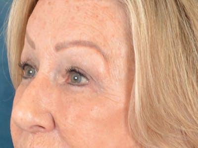 Eyelid Lift Before & After Gallery - Patient 293080 - Image 8