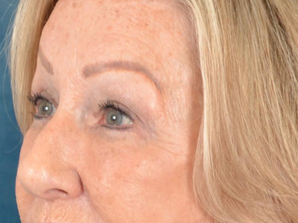 Eyelid Lift Before & After Gallery - Patient 293080 - Image 8