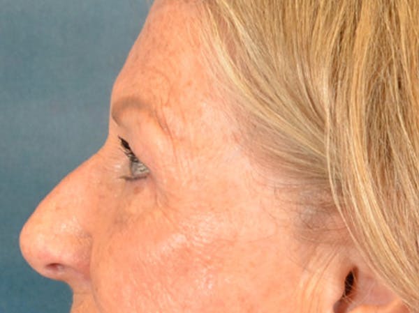 Eyelid Lift Before & After Gallery - Patient 293080 - Image 9