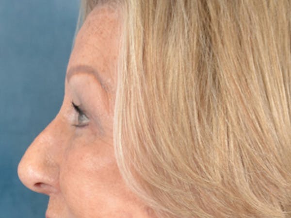 Eyelid Lift Before & After Gallery - Patient 293080 - Image 10