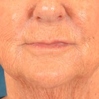 Lip Lift Before & After Gallery - Patient 139841 - Image 1