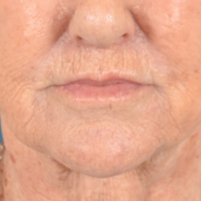 Lip Lift Before & After Gallery - Patient 139841 - Image 2