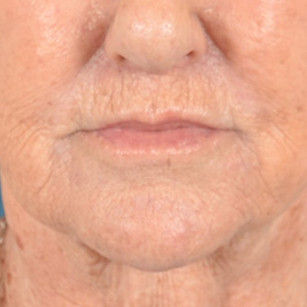 Lip Lift Before & After Gallery - Patient 139841 - Image 2