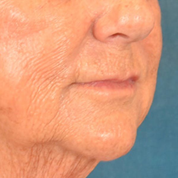 Lip Lift Before & After Gallery - Patient 139841 - Image 3