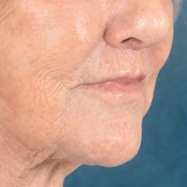 Lip Lift Before & After Gallery - Patient 139841 - Image 4
