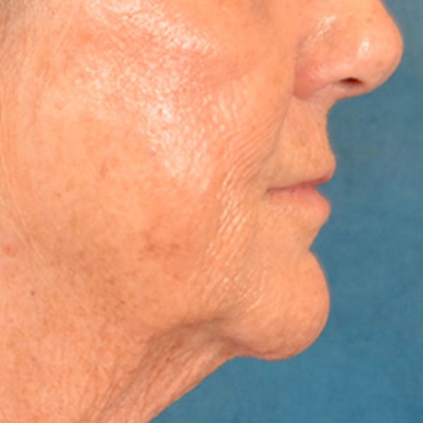 Lip Lift Before & After Gallery - Patient 139841 - Image 5