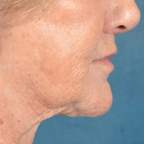Lip Lift Before & After Gallery - Patient 139841 - Image 6