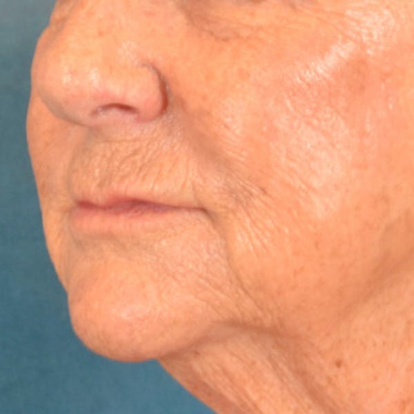 Lip Lift Before & After Gallery - Patient 139841 - Image 7