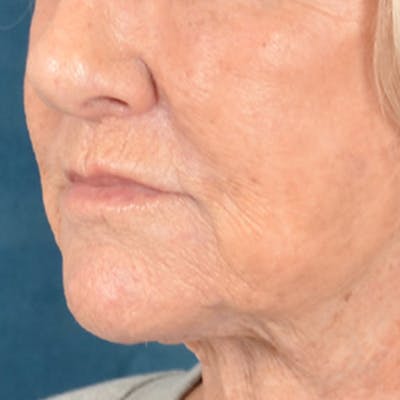 Lip Lift Before & After Gallery - Patient 139841 - Image 8