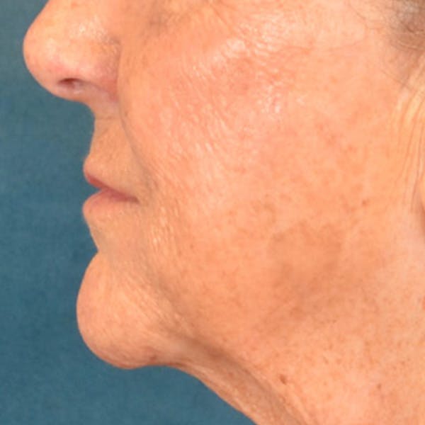 Lip Lift Before & After Gallery - Patient 139841 - Image 9
