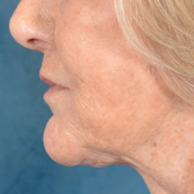 Lip Lift Before & After Gallery - Patient 139841 - Image 10