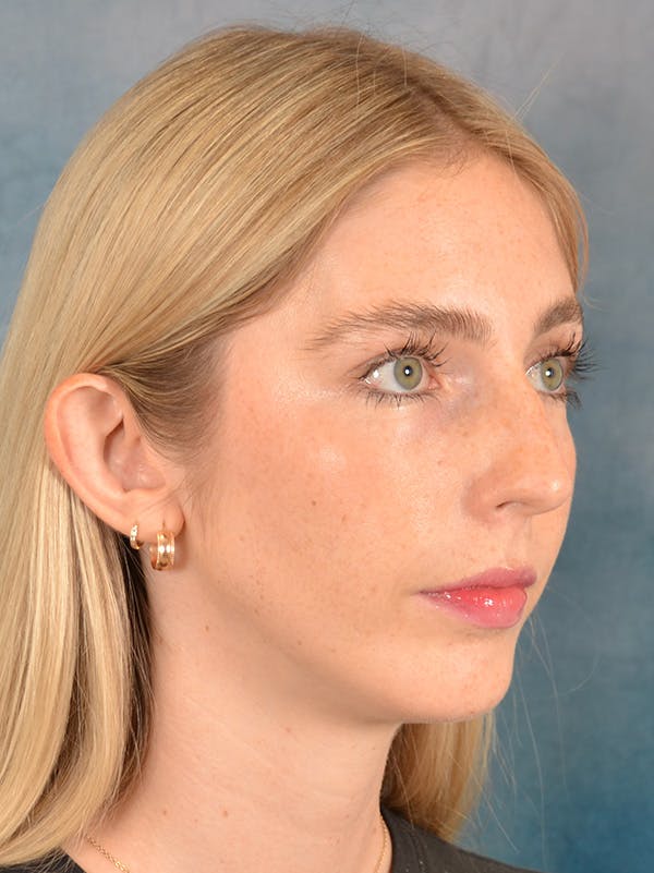 Rhinoplasty Before & After Gallery - Patient 140653 - Image 7