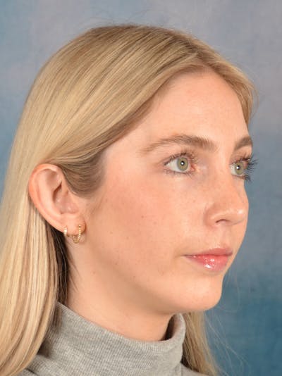 Rhinoplasty Before & After Gallery - Patient 140653 - Image 8
