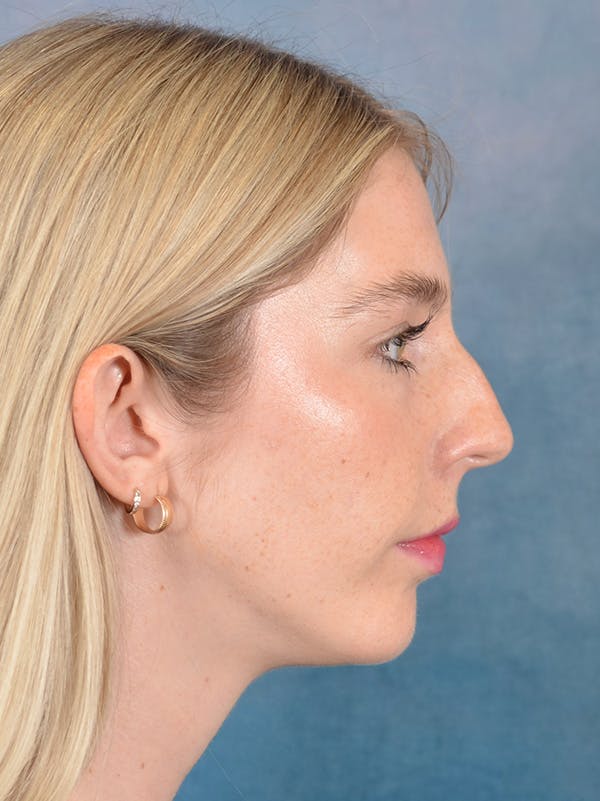 Rhinoplasty Before & After Gallery - Patient 140653 - Image 9