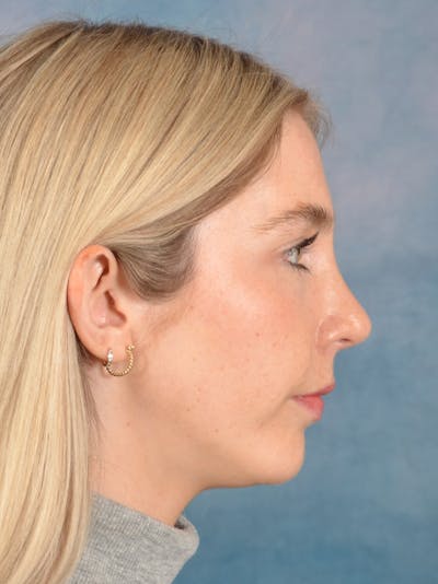 Rhinoplasty Before & After Gallery - Patient 140653 - Image 10