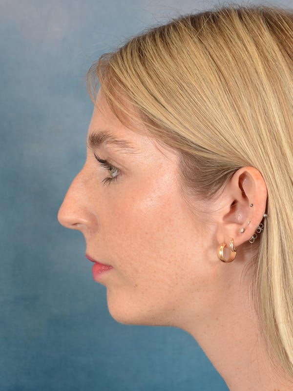 Rhinoplasty Before & After Gallery - Patient 140653 - Image 1
