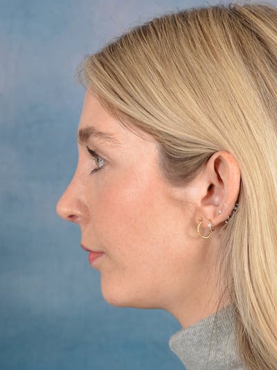 Rhinoplasty Before & After Gallery - Patient 140653 - Image 2