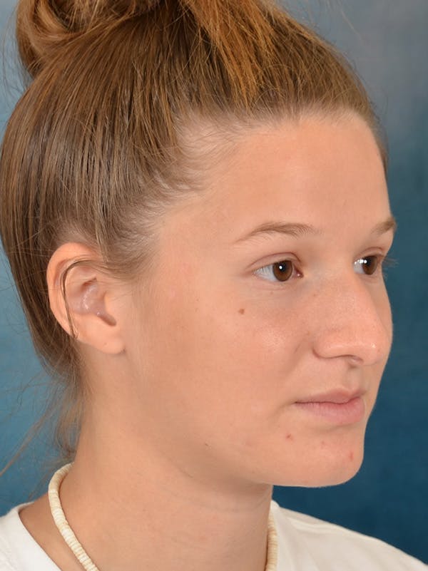 Rhinoplasty Before & After Gallery - Patient 158444426 - Image 7