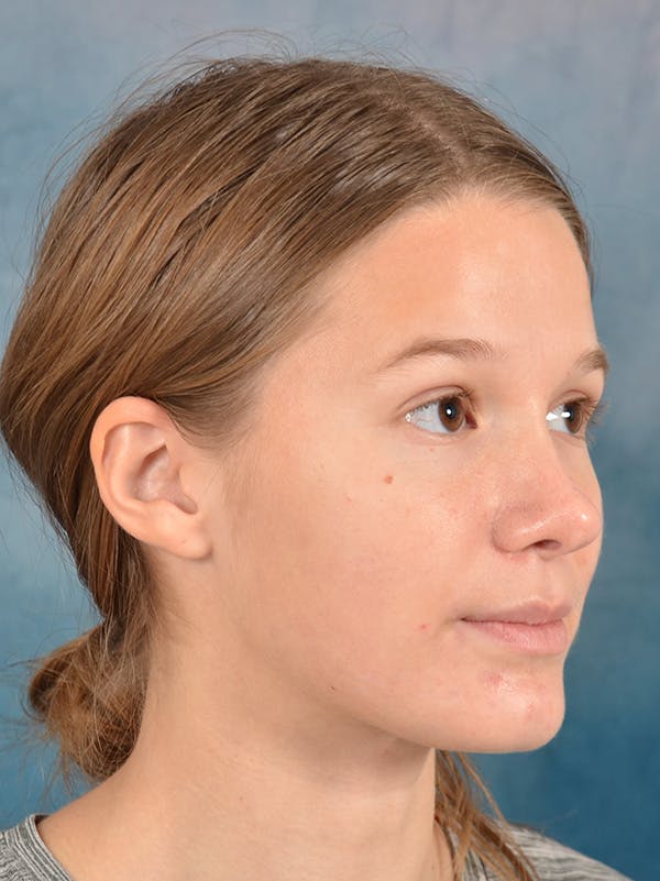 Rhinoplasty Before & After Gallery - Patient 158444426 - Image 8