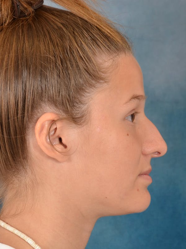 Rhinoplasty Before & After Gallery - Patient 158444426 - Image 9