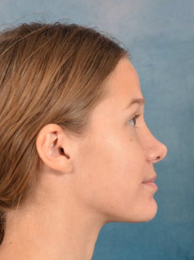 Rhinoplasty Before & After Gallery - Patient 158444426 - Image 10