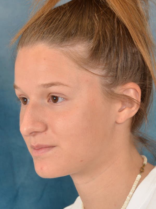 Rhinoplasty Before & After Gallery - Patient 158444426 - Image 3