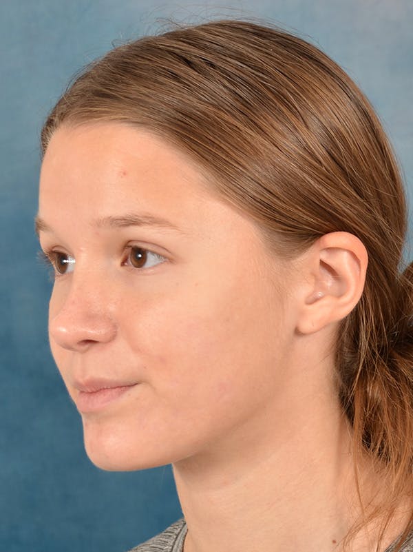 Rhinoplasty Before & After Gallery - Patient 158444426 - Image 4