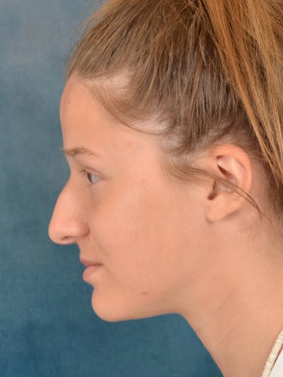 Rhinoplasty Before & After Gallery - Patient 158444426 - Image 1