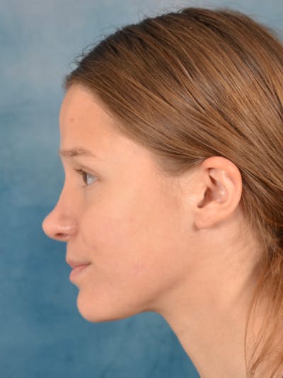 Rhinoplasty Before & After Gallery - Patient 158444426 - Image 2