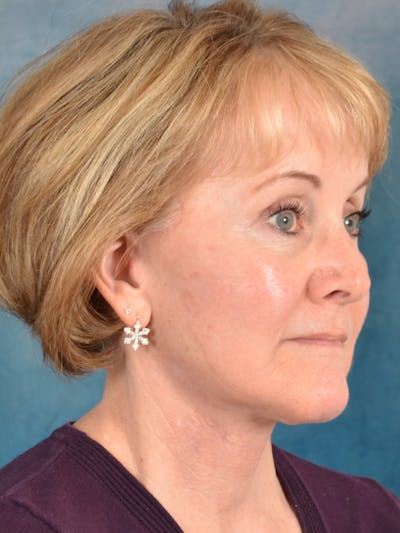 Deep Plane Facelift Before & After Gallery - Patient 212680 - Image 8