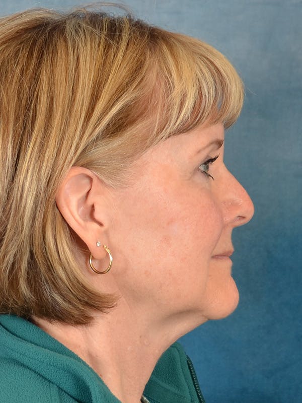 Deep Plane Facelift Before & After Gallery - Patient 212680 - Image 9