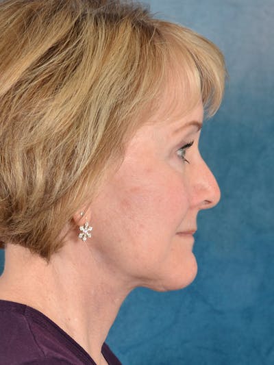 Deep Plane Facelift Before & After Gallery - Patient 212680 - Image 10