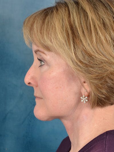 Brow Lift Before & After Gallery - Patient 588234 - Image 6