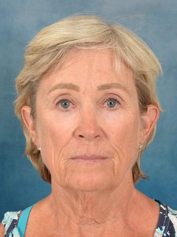 Deep Plane Facelift Before & After Gallery - Patient 147586 - Image 3
