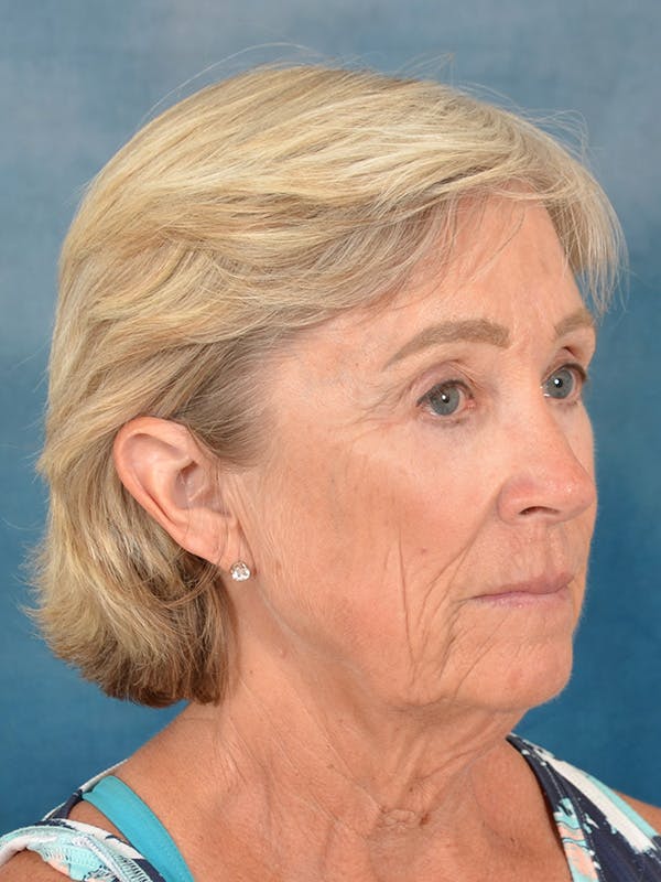 Deep Plane Facelift Before & After Gallery - Patient 147586 - Image 5
