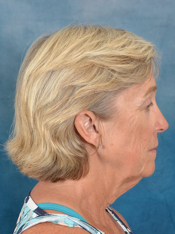 Deep Plane Facelift Before & After Gallery - Patient 147586 - Image 7
