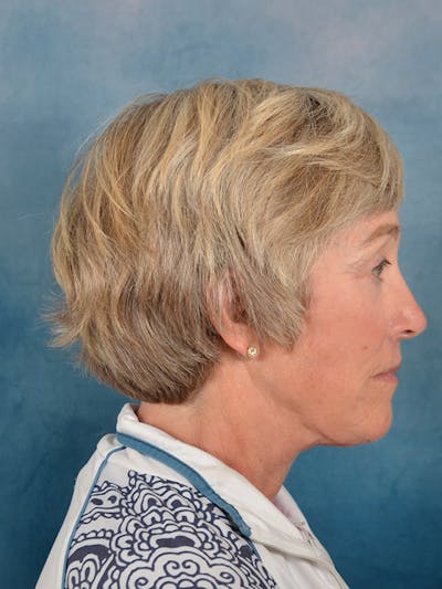 Deep Plane Facelift Before & After Gallery - Patient 147586 - Image 8