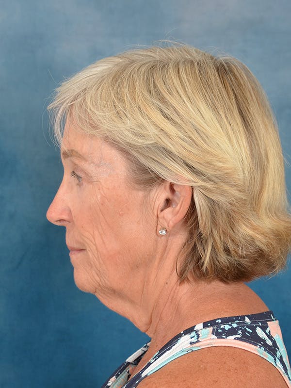 Deep Plane Facelift Before & After Gallery - Patient 147586 - Image 9