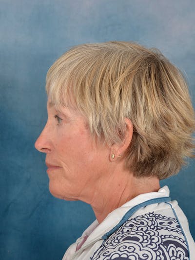 Deep Plane Facelift Before & After Gallery - Patient 147586 - Image 10