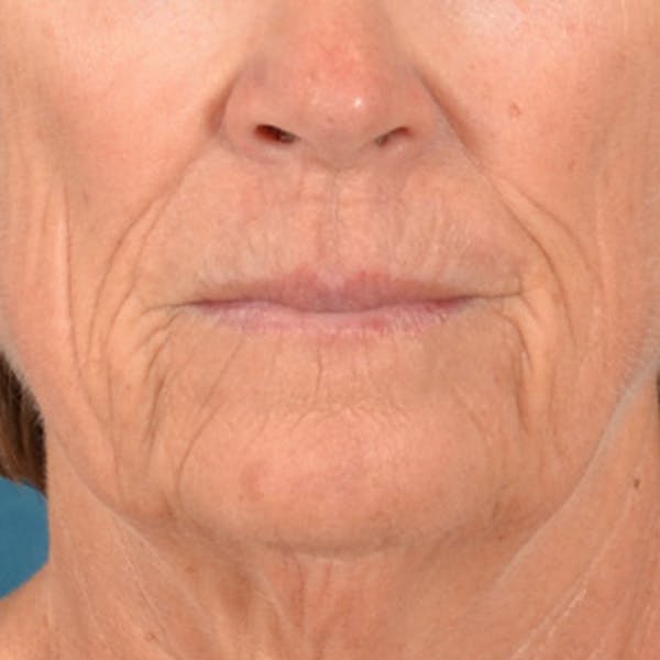 Lip Lift Before & After Gallery - Patient 257081 - Image 1