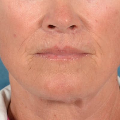 Lip Lift Before & After Gallery - Patient 257081 - Image 2
