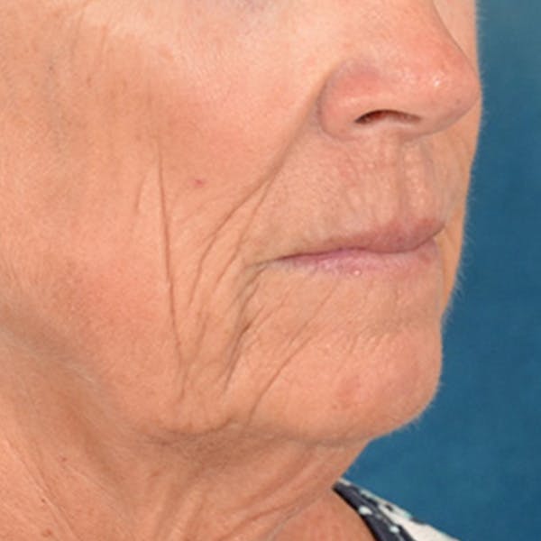 Lip Lift Before & After Gallery - Patient 257081 - Image 3