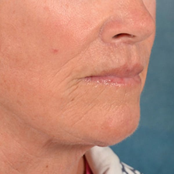 Lip Lift Before & After Gallery - Patient 257081 - Image 4