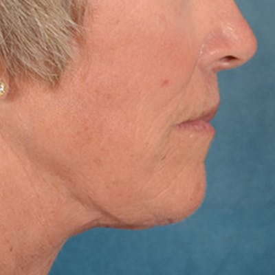Lip Lift Before & After Gallery - Patient 257081 - Image 6