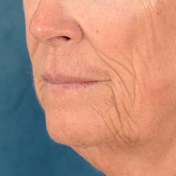 Lip Lift Before & After Gallery - Patient 257081 - Image 7