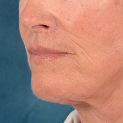 Lip Lift Before & After Gallery - Patient 257081 - Image 8