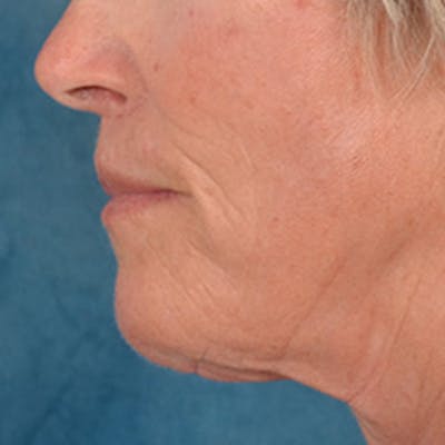 Lip Lift Before & After Gallery - Patient 257081 - Image 10