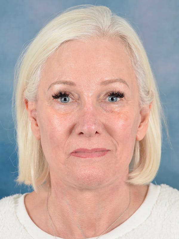 Deep Plane Facelift Before & After Gallery - Patient 271636 - Image 4