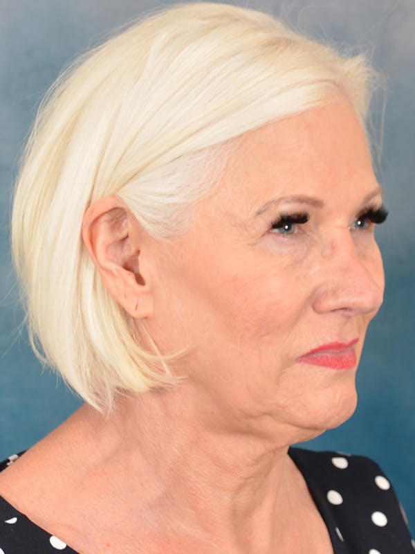 Deep Plane Facelift Before & After Gallery - Patient 271636 - Image 5